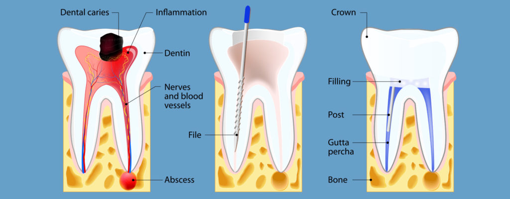 Root Canal Therapy - Pike Creek Dental