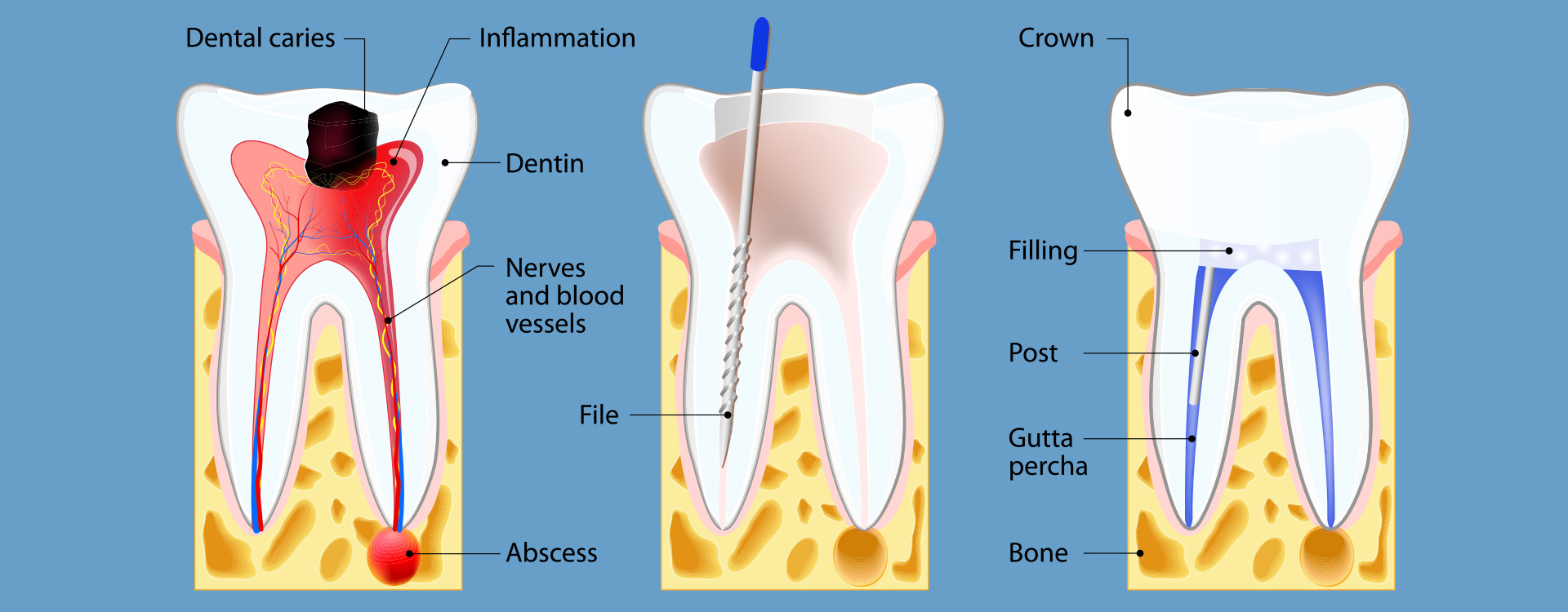 root-canal-therapy-pike-creek-dental